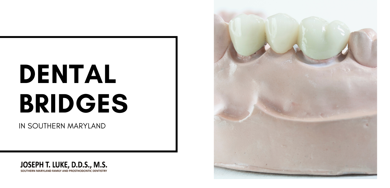 Dental Bridges Southern Maryland