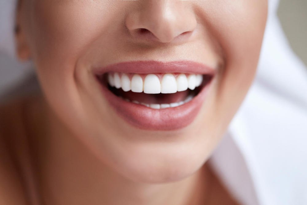 What Is the Veneer Cost in St. Marys?