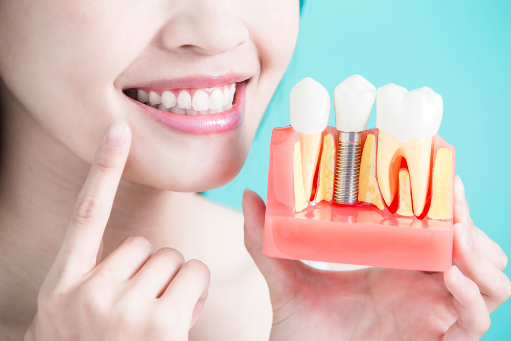 Dental Implant Cost in California