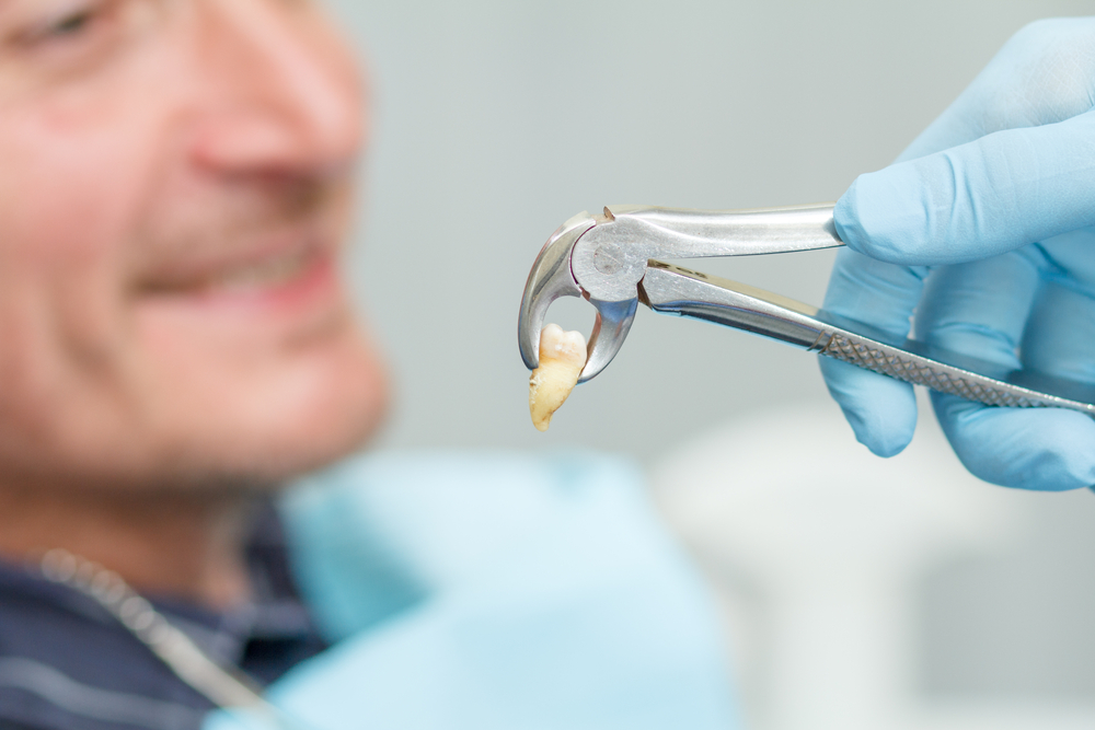 Emergency Tooth Extraction in Prince Frederick MD