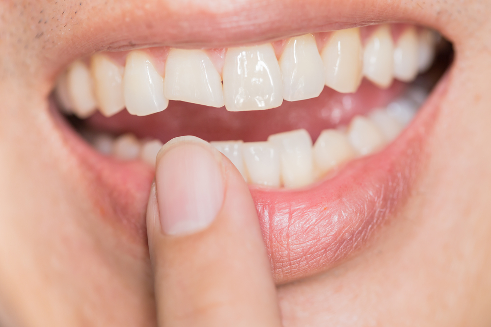 Have a Cracked Tooth in Waldorf Maryland?