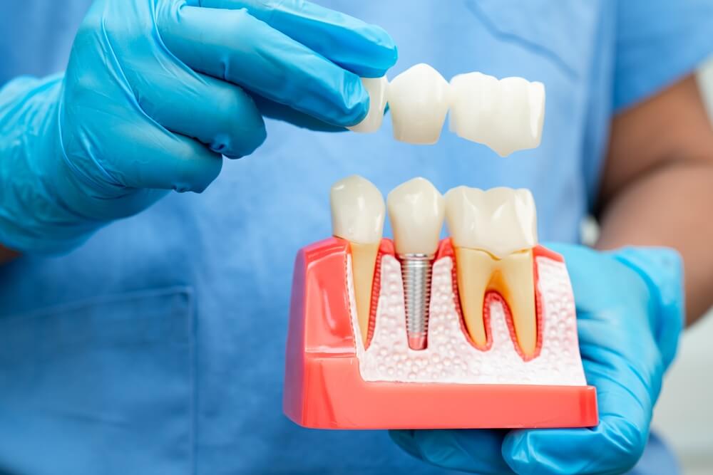 doctor comparing dental implants vs dental bridges