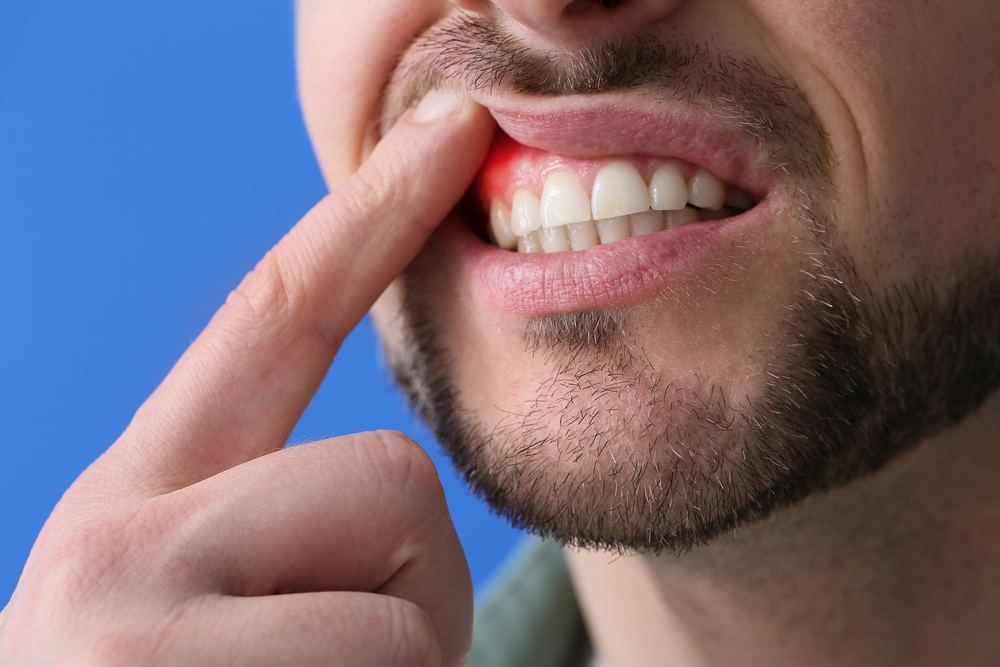 man with advanced gum disease in Leonardtown