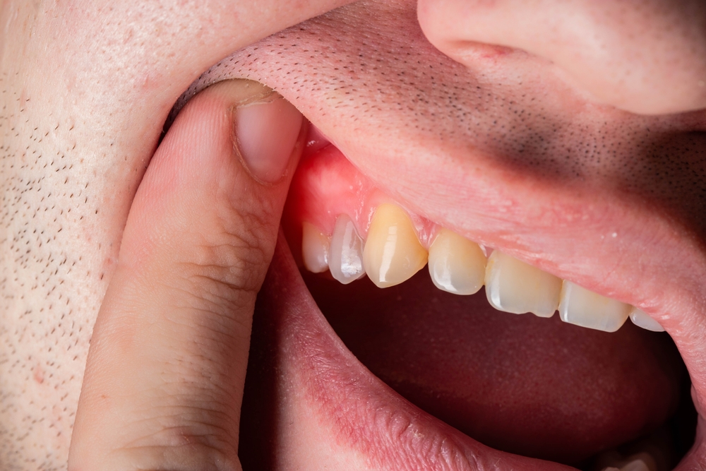 periodontal disease Leonardtown MD