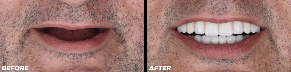 before and after of patient post All-on-X full arch restoration