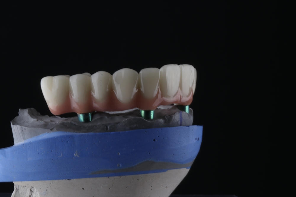 All-on-X full arch surgery in Calvert County