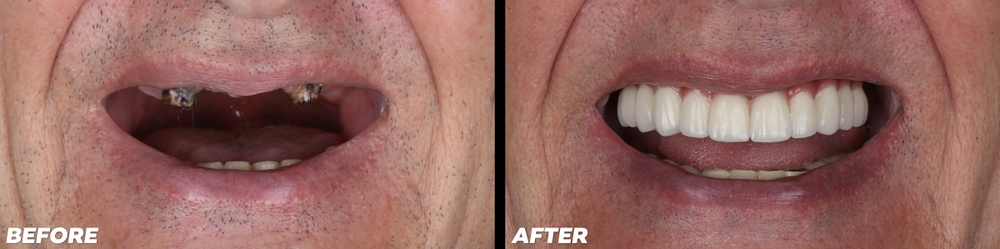 full mouth restoration before and after results