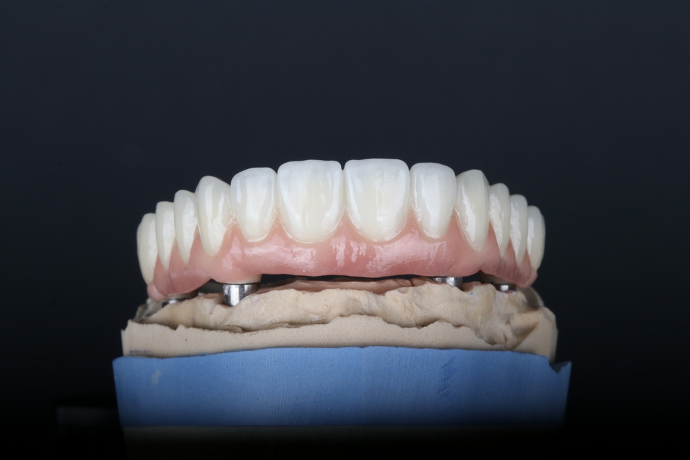 implants for full-arch surgery in Prince Frederick MD