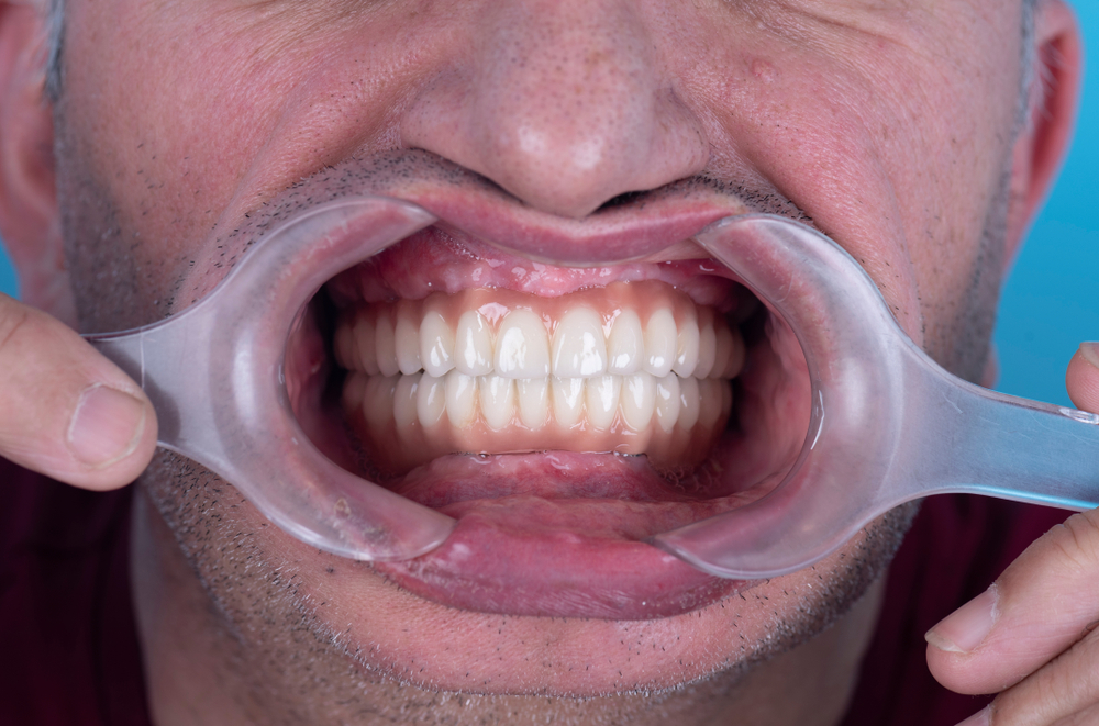 complex full mouth reconstruction in Calvert County