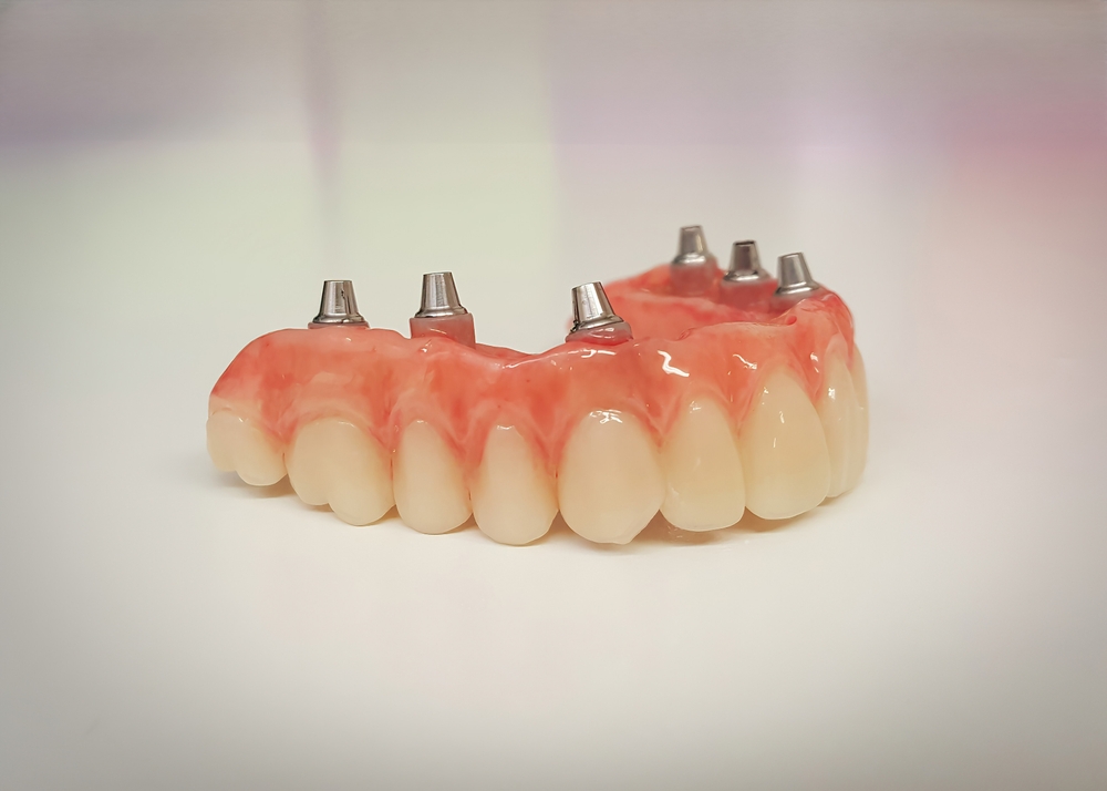all-on-6 arch restoration
